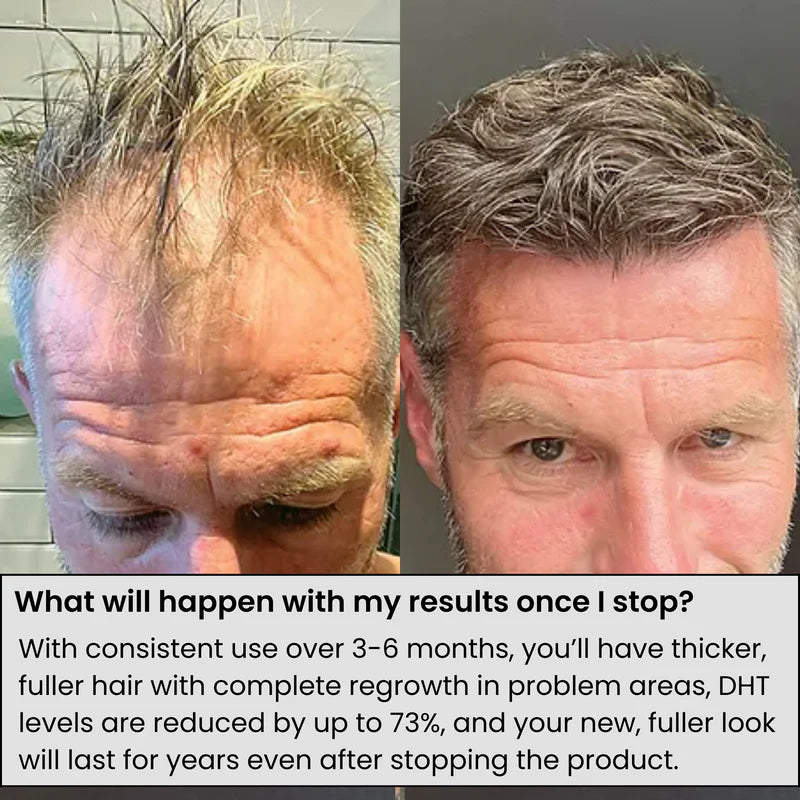 AlphaInfuse™ Starter Kit | 1-Month Hair Regrowth & Infusion System for Fuller Hair